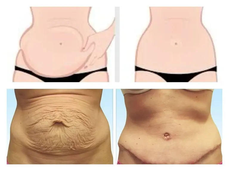 Cirugías de reconstrucción abdominal con Bono PAD crecen más de un 30% en el país