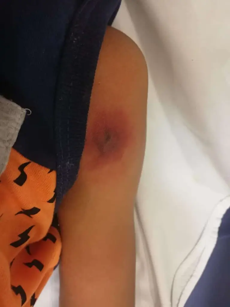Hospitalizado niño mordido por araña de rincón en Maipú: vecina dispara contra condominio infestado de arañas