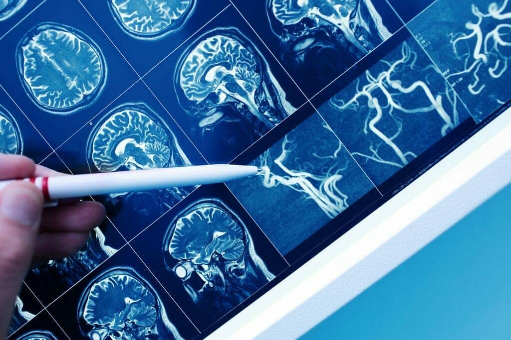 diagnóstico epilepsia