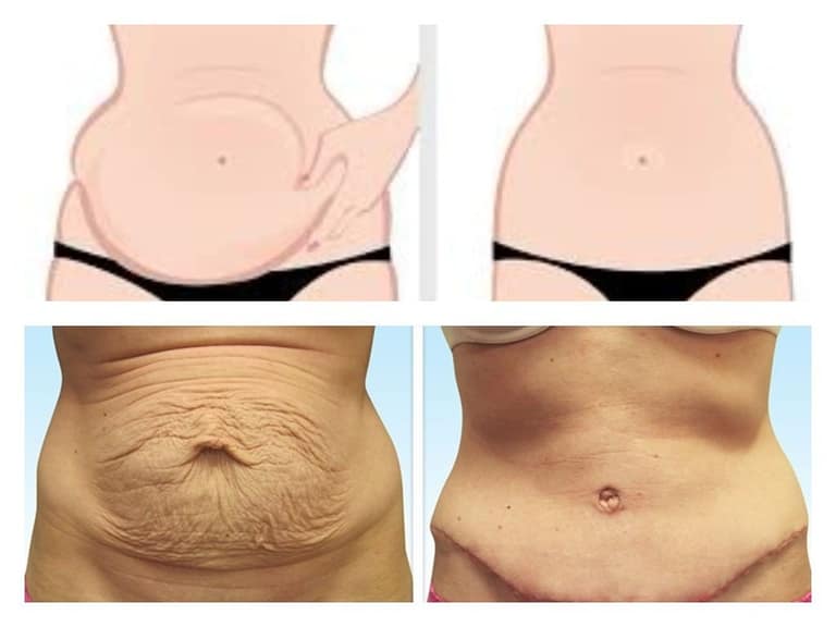 Cirugías de reconstrucción abdominal con Bono PAD crecen más de un 30% en el país