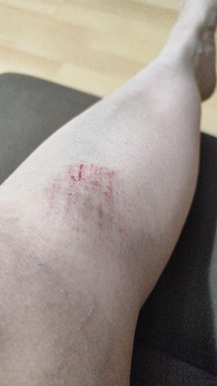 La rodilla de Elizabeth días después.
