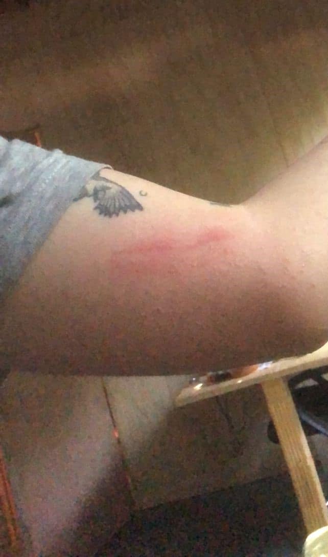 lesiones secuestro