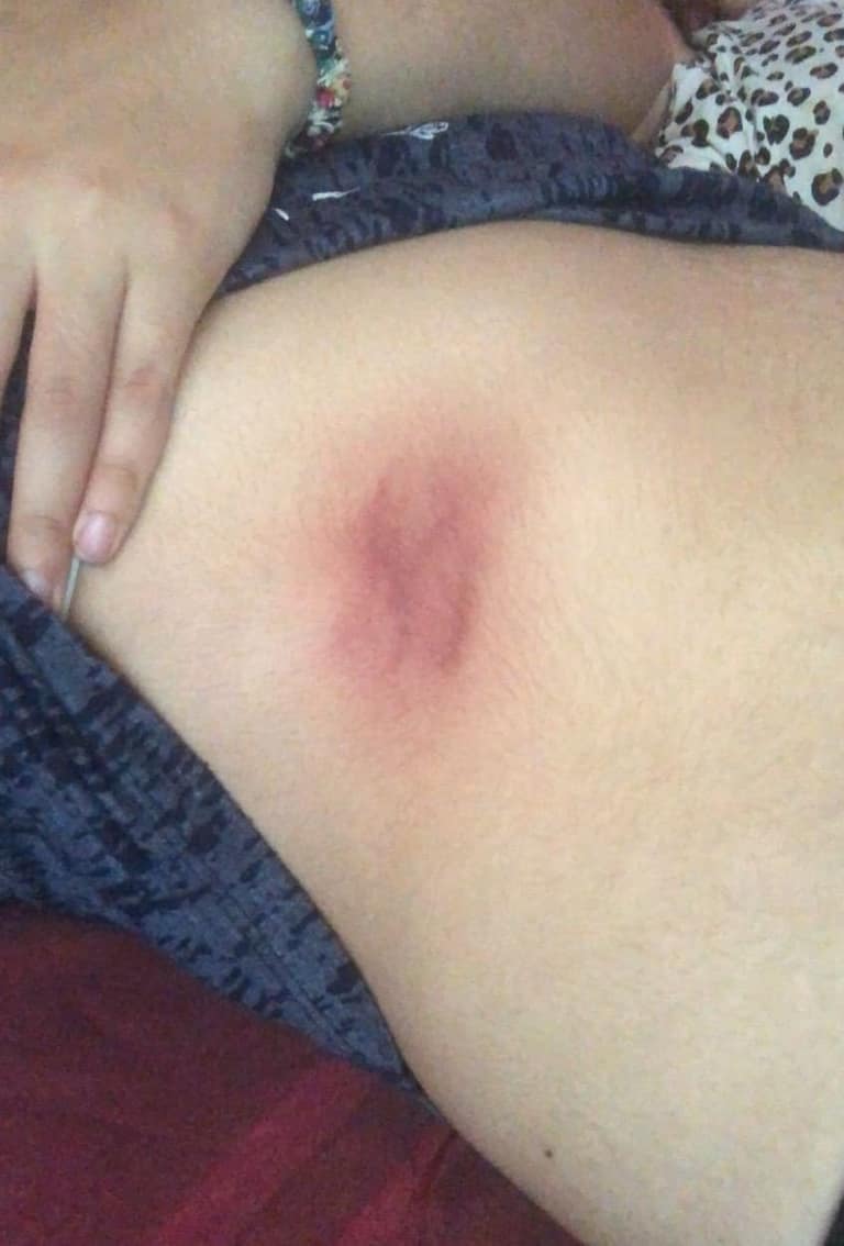 lesiones secuestro